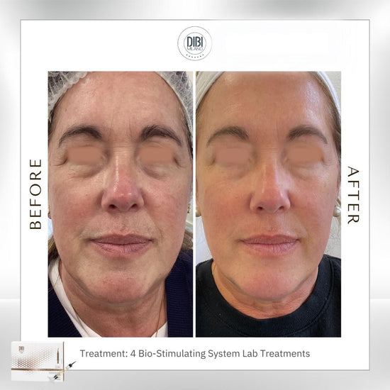 Image Title Skinpen Polynucleotide Facial